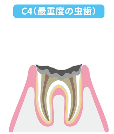 歯周病